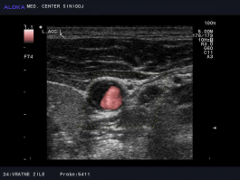 Ultrazvok vratnih žil - ateroskleroza skupne karotidne arterije, prečno